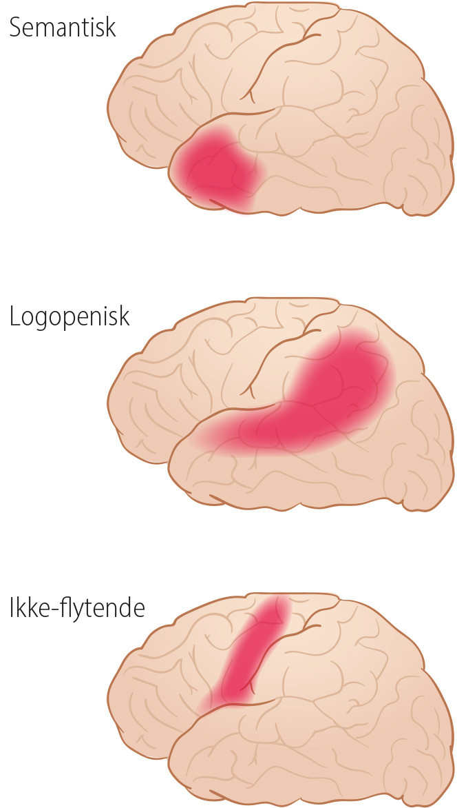 Figur 1 Forenklet fremstilling av utbredelse av hypometabolisme ved FDG-PET og atrofi p&aring; MR av hjernen ved ulike prim&aelig;r&hellip;