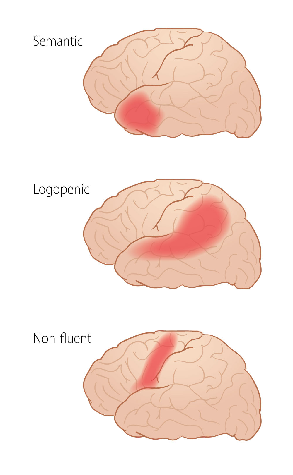 Figure 1 Simplified representation of the extent of brain hypometabolism on FDG-PET, and brain atrophy on MRI, in different&hellip;