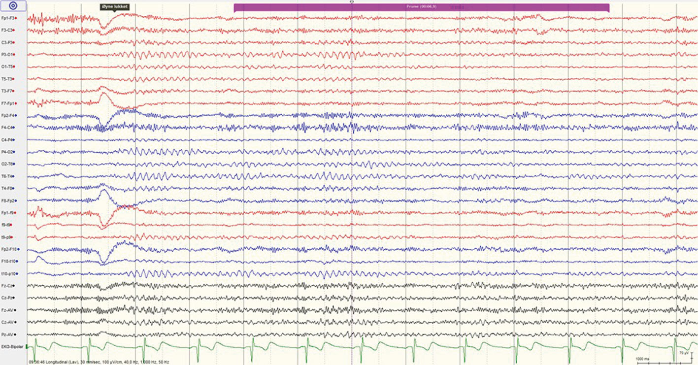 Figur 1 26-elektroders EEG-registering med normale funn f&oslash;r oppstart av elektrokonvulsiv behandling.