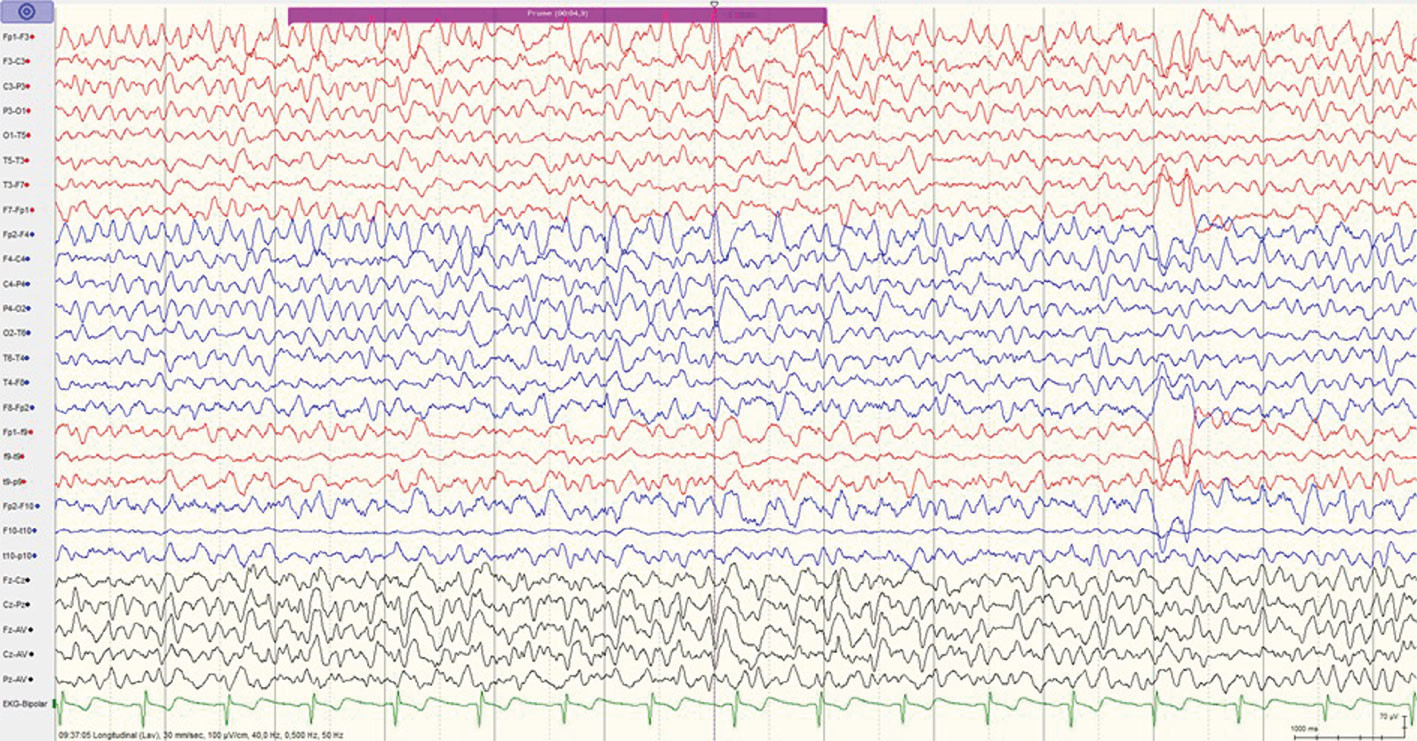 Figur 2 26-elektroders EEG-registrering fire dager etter avsluttet elektrokonvulsiv behandling viser generalisert theta&hellip;