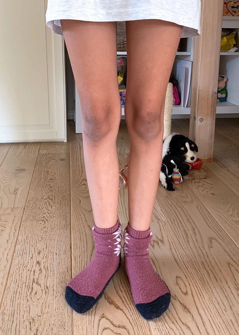 Figur 1 Bilde tatt f&aring; dager f&oslash;r innleggelse viser hyperpigmentering av begge kn&aelig;r og solbrun farge til tross for solfattig&hellip;