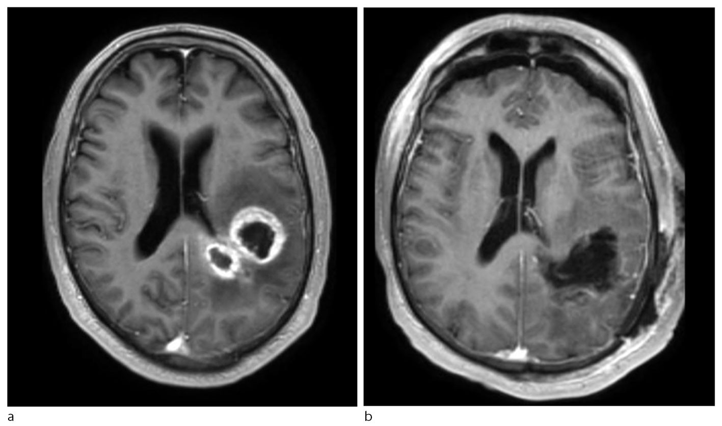 Figur 1 T1-vektet MR med kontrast av et venstresidig frontoparietalt glioblastom (a). Postoperativt bilde viser&hellip;