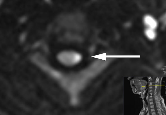 Figur 2 Aksialt diffusjonsvektet MR-bilde (B1000) i niv&aring; C2/3 viser omr&aring;de med h&oslash;yt signal til venstre i medulla, tydende p&aring;&hellip;