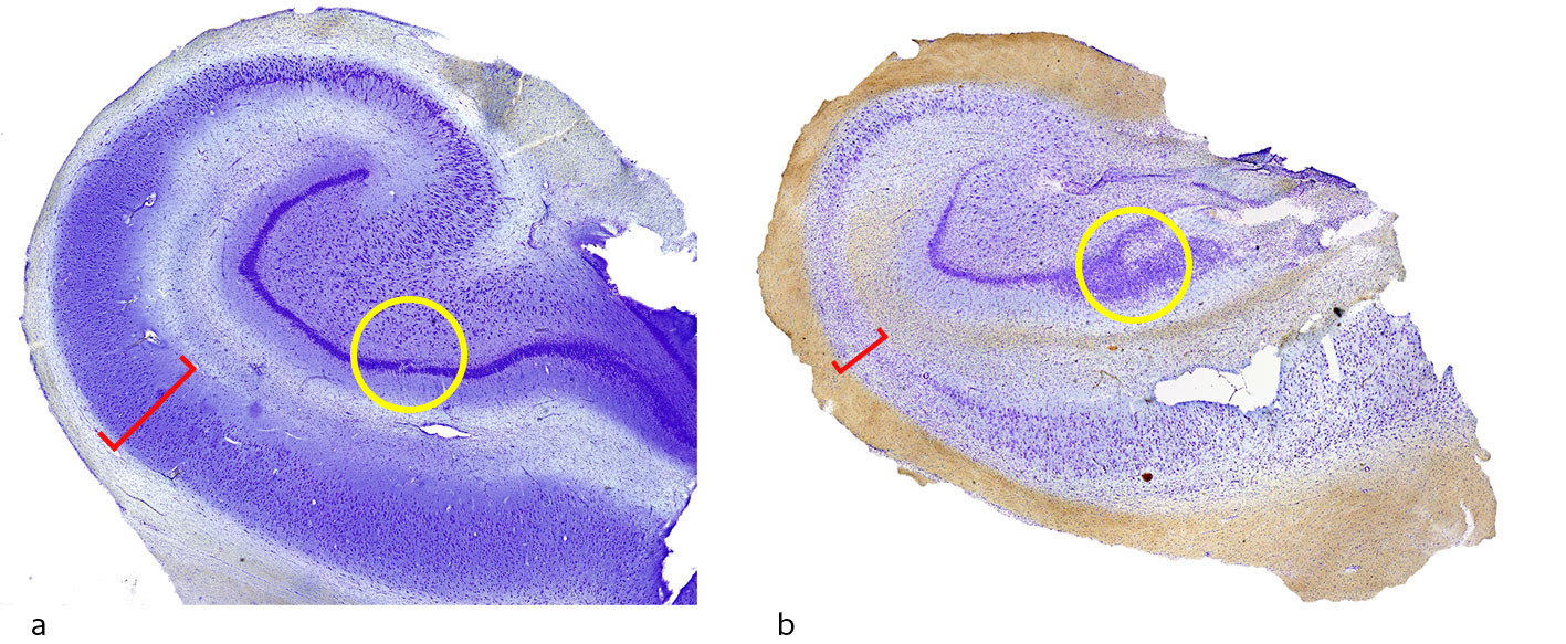 Figur 1 Tverrsnitt av hippocampus med Nissl-farging for fremstilling av nevroner. a) normal hippocampus og b) sklerotisk&hellip;