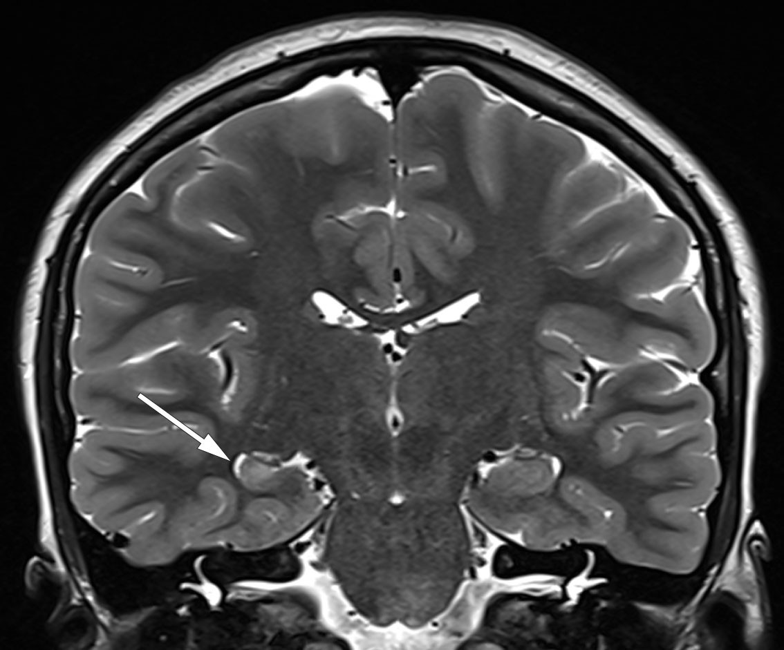 Figure 2 MRI in a patient with temporal lobe epilepsy obtained using an epilepsy protocol in a 3 Tesla scanner. A coronal T2&hellip;