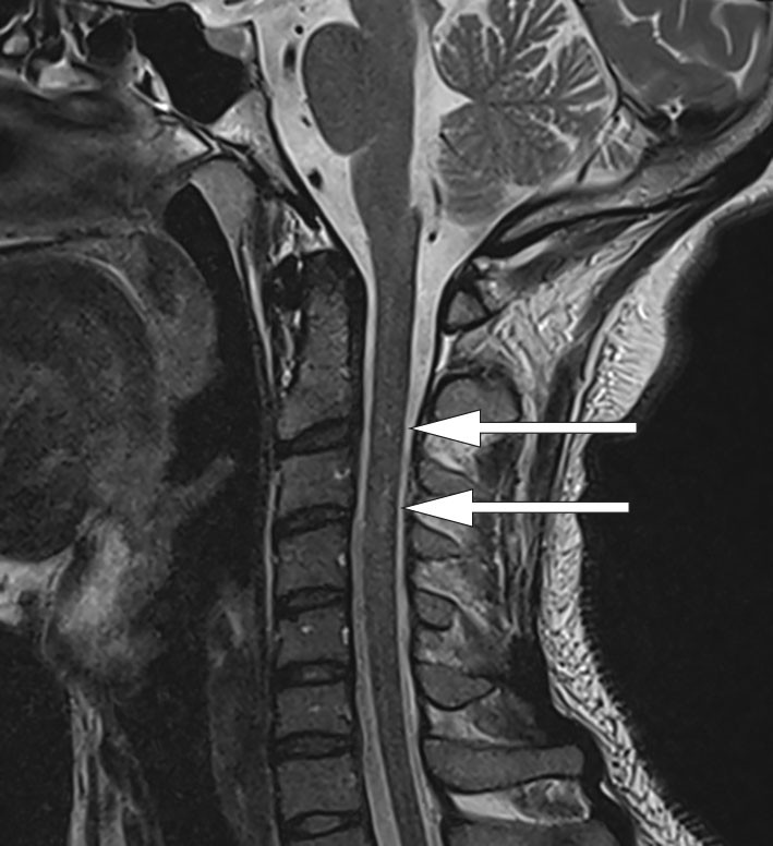 Figure 1 MRI of the cervical spine revealed high signal changes in the spinal cord at the C3 level.