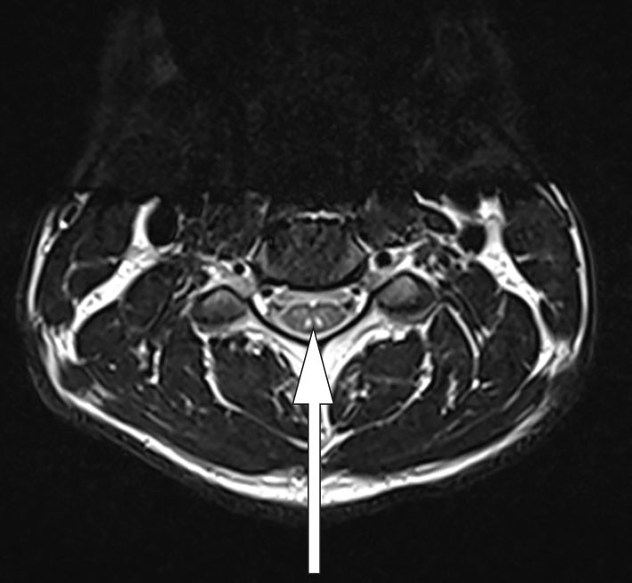 Figure 2 MRI of the cervical spine revealed symmetrical high signal changes with the appearance of an inverted V or 'rabbit&hellip;