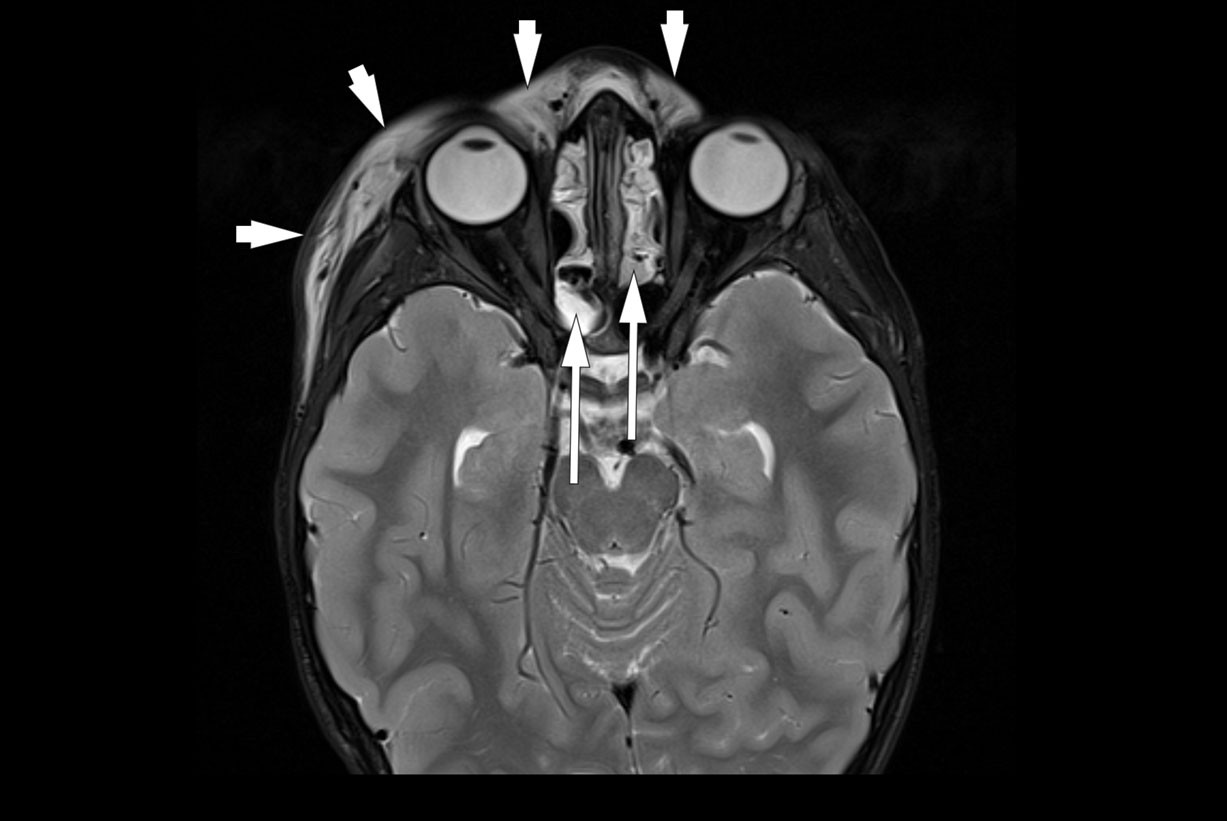 Figur 1 Aksial, fettsaturert T2-vektet magnetresonanstomografi (MR) viste bl&oslash;tvevshevelse i underhuden omkring h&oslash;yre &oslash;ye med&hellip;