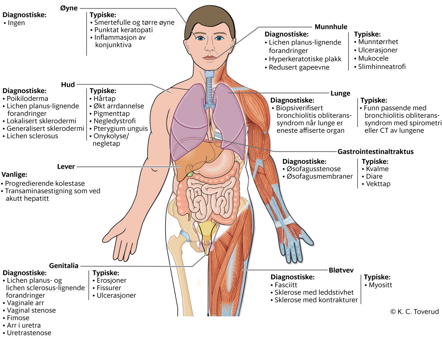 Figur 1 Kliniske manifestasjoner ved kronisk transplantat-mot-vert-sykdom. Ved diagnostiske manifestasjoner kan diagnosen&hellip;