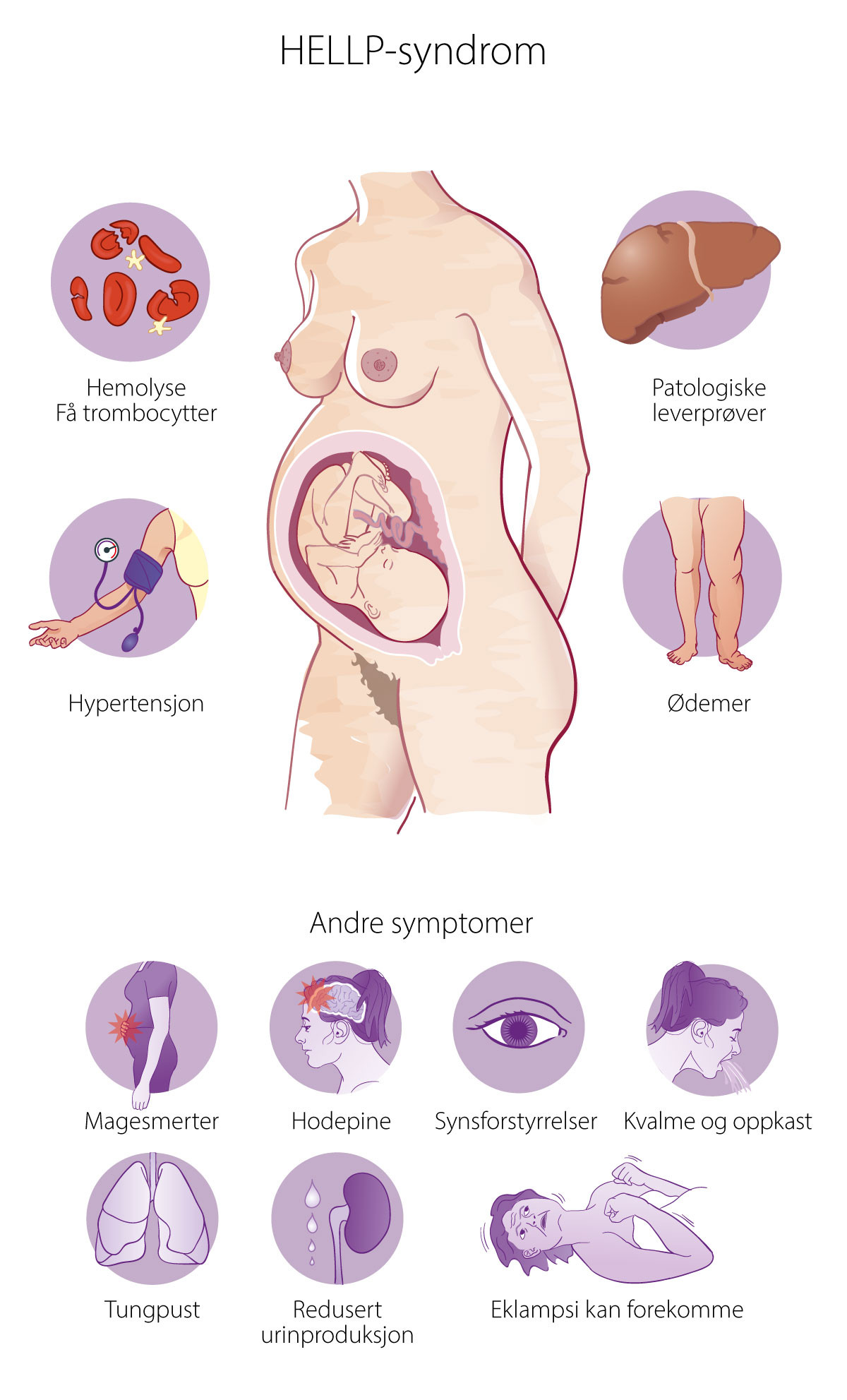 Figur 1 Symptomer ved HELLP-syndrom. Alle symptomene er ikke n&oslash;dvendigvis til stede, og symptomene opptrer heller ikke&hellip;