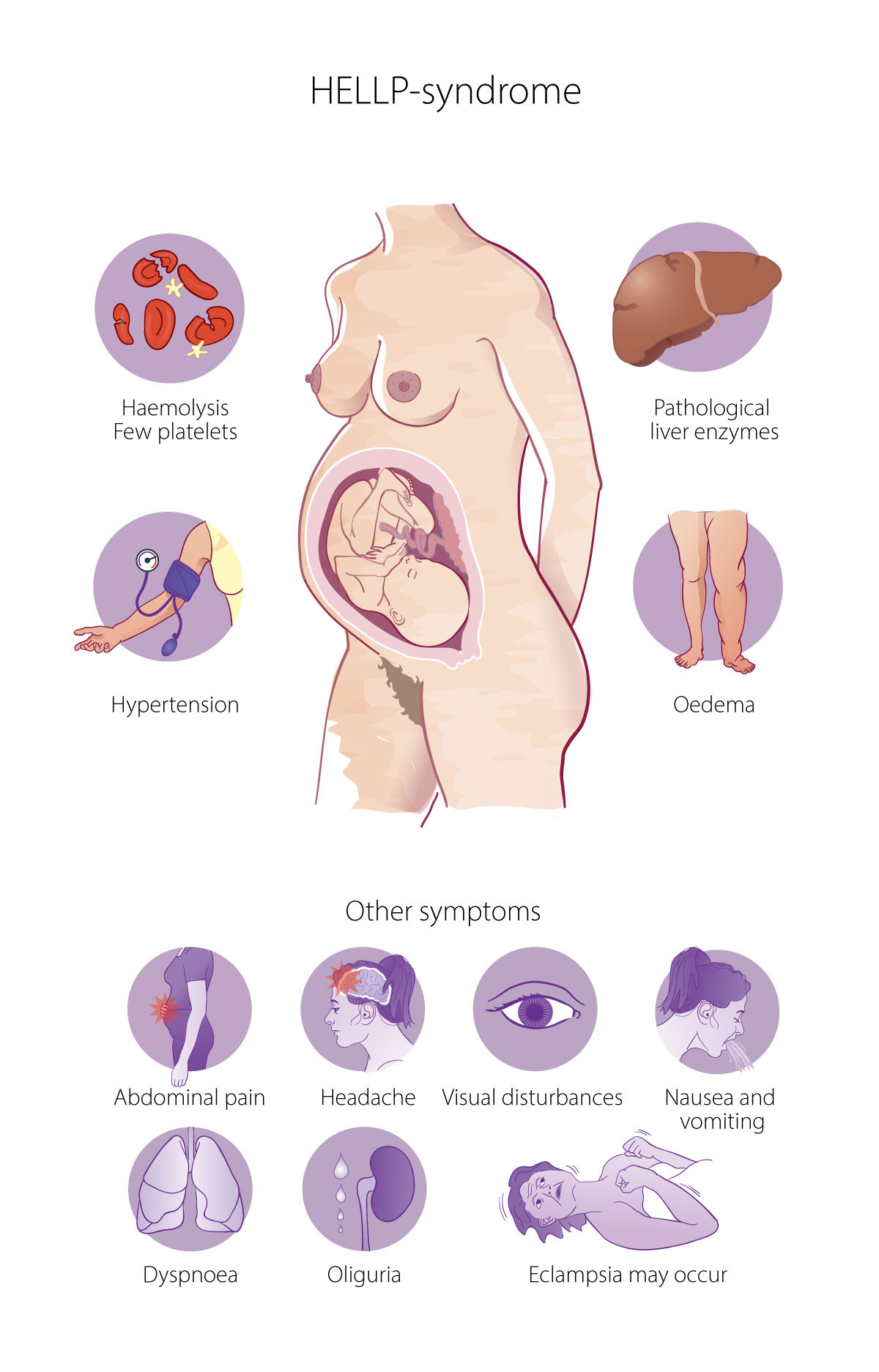 Figure 1 Symptoms of HELLP syndrome. Not all symptoms are necessarily present, nor do the symptoms always appear at the same&hellip;