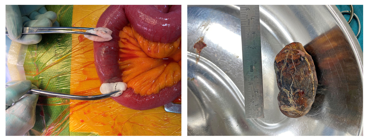 Figure 1 Obstruction in the small bowel before enterotomy (on left) and extracted gallstone (on right).