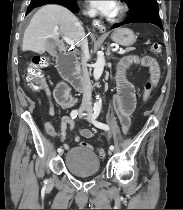 Figure 2 CT, coronal section. The arrow indicates a fistula between the gallbladder, which has abnormal wall thickening, and&hellip;