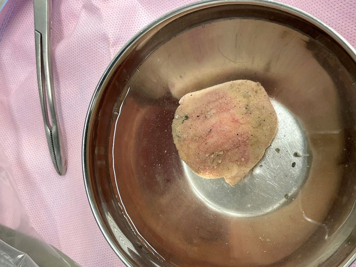 Figur 1 Tungedel f&oslash;r operasjon.