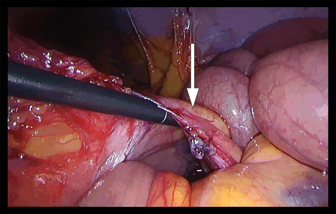 Figure 1 Laparoscopy with finding of left paraduodenal hernia. The arrow indicates the inferior mesenteric vein. Intestinal&hellip;