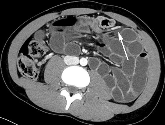 Figure 2 Axial section. Dilated ileum loops in left anterior pararenal space. Ascending branch of the left colic artery&hellip;