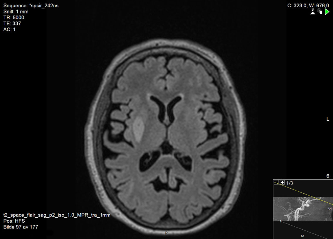 Figure 1 Brain MRI in vascular parkinsonism, subtype 1. T2-FLAIR sequence shows hyperintensity in the right putamen, in this&hellip;
