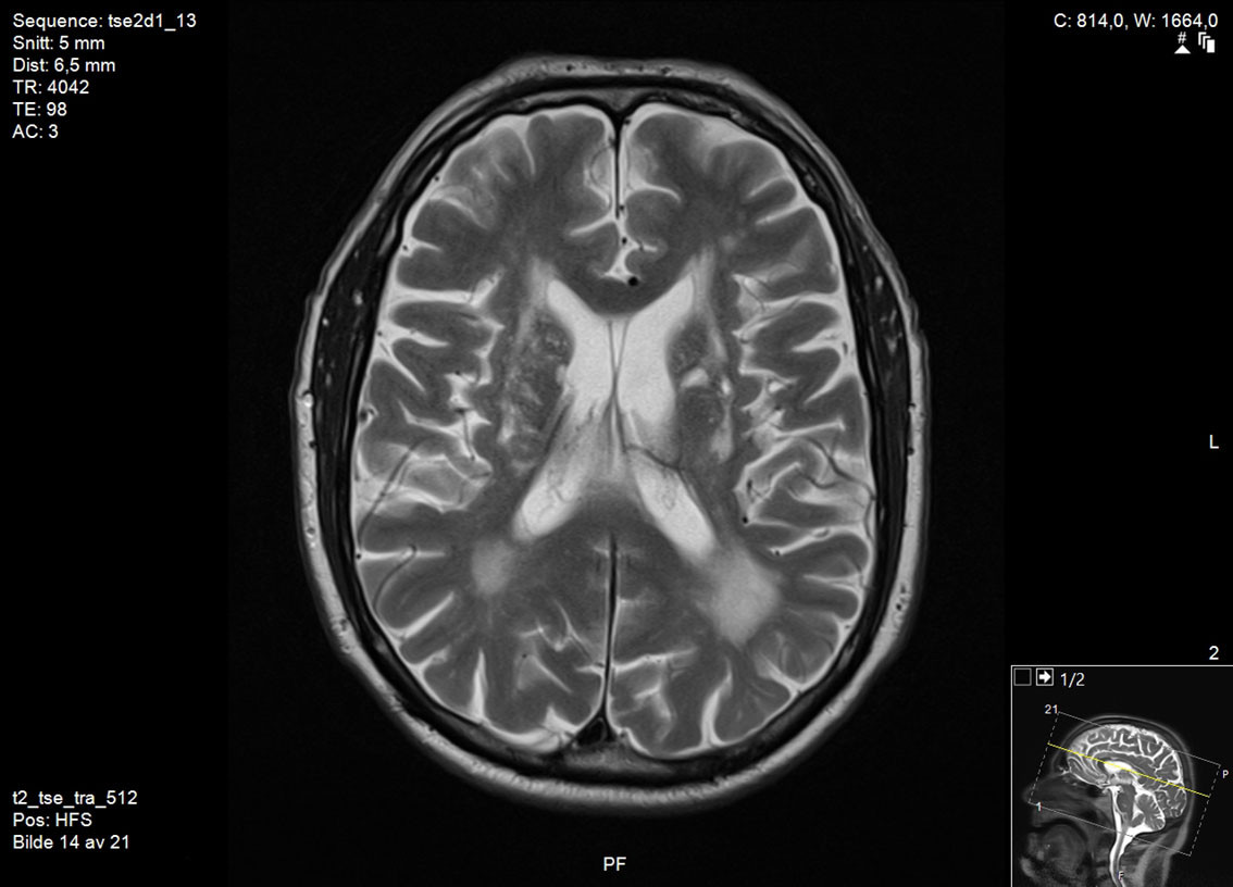 Figure 2 Brain MRI in vascular parkinsonism, subtype 2. T2-weighted image shows white matter hyperintensities, markedly&hellip;