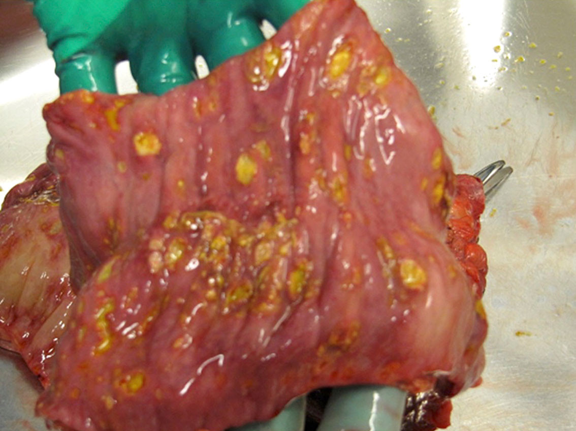 Figur 1 Kolonresektat med multiple ulcerasjoner. Preparatet er klippet opp, og her sees innsiden av kolon. Bildet er tatt p&aring;&hellip;