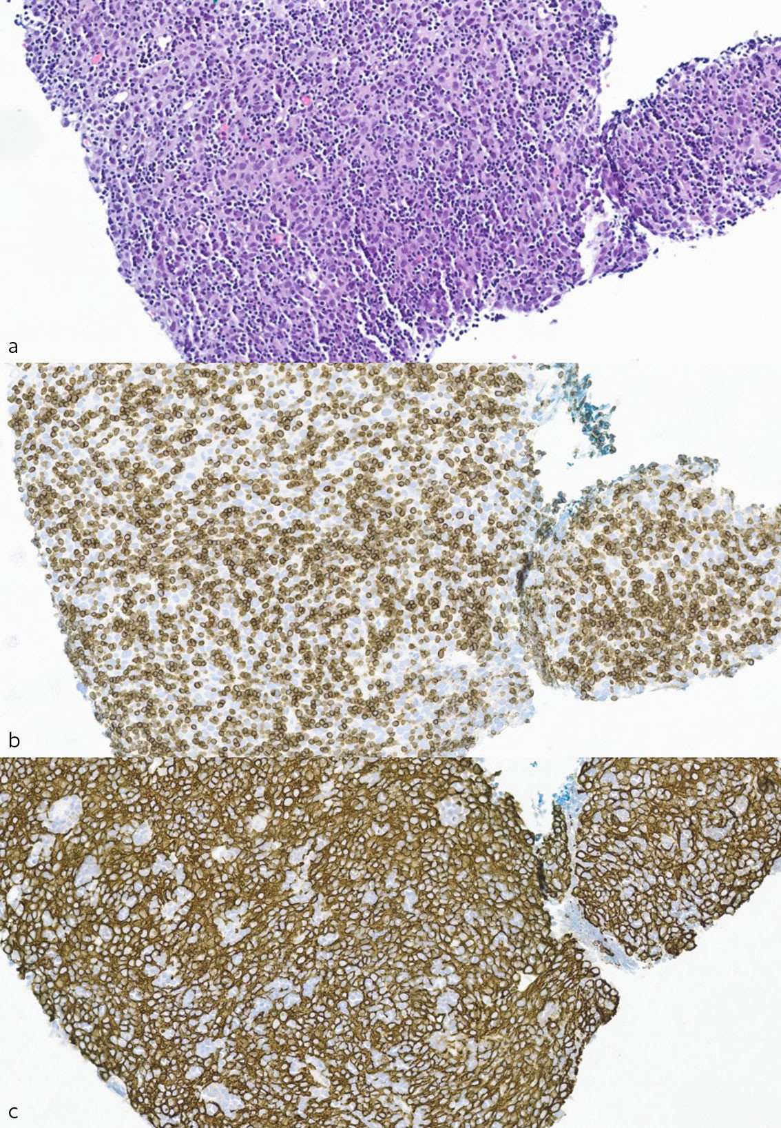 Figur 2 Snitt fra CT-veiledet biopsi av pleurametastase, ca. 400 gangers forst&oslash;rrelse. a) Hematoksylin-eosin-safranfarget&hellip;