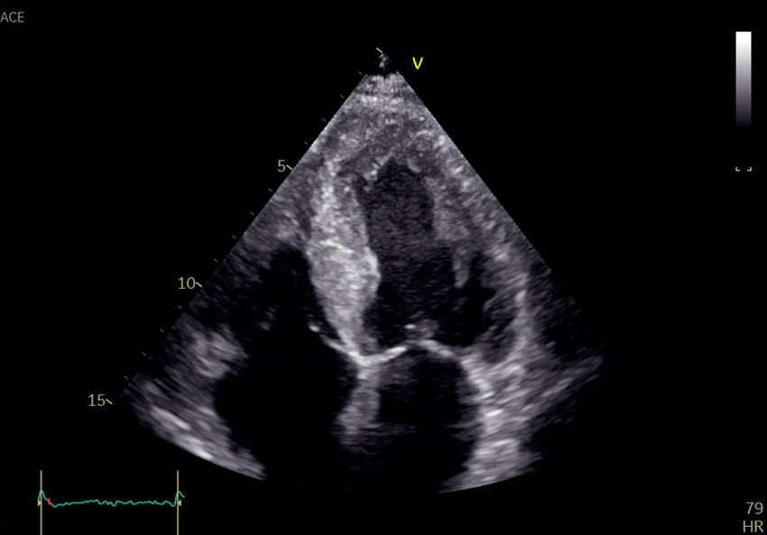 Figure 1 Echocardiography. Apical four-chamber view shows thickening of the left ventricular wall and a granular appearance&hellip;