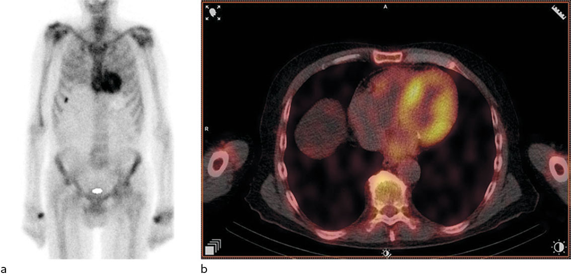 Figur 2 99&nbsp;mTc-DPD-scintigrafi. Planart bilde (a) og SPECT-CT (b) viser sterkt positivt signal i myokard. Dette funnet er&hellip;