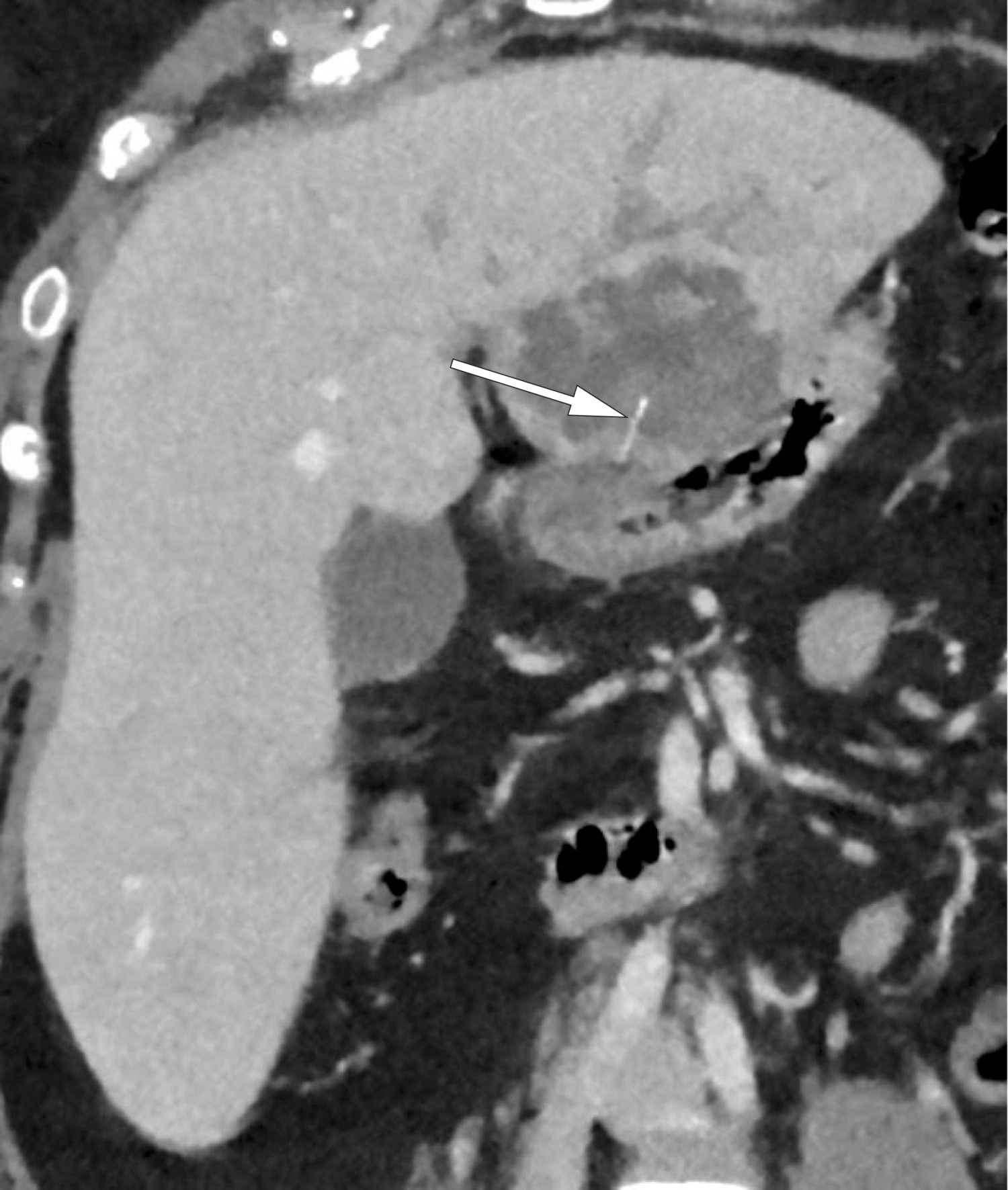 Figur 1 CT-unders&oslash;kelse av abdomen etter intraven&oslash;s kontrast i portoven&oslash;s fase med skr&aring; koronal reformatering viste et 15&nbsp;mm&hellip;