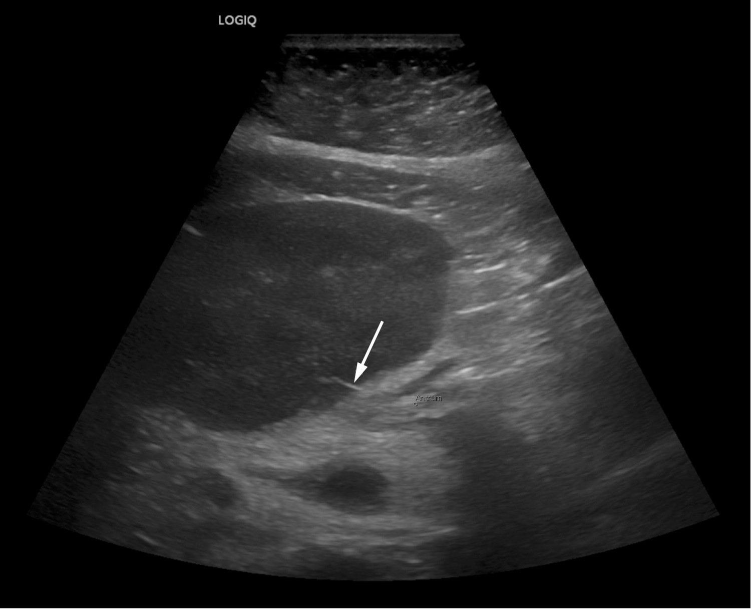 Figur 2 Ultralyd som ble utf&oslash;rt i forbindelse med drensinnleggelse viste et smalt ekkogent legeme svarende til funnet p&aring; CT&hellip;