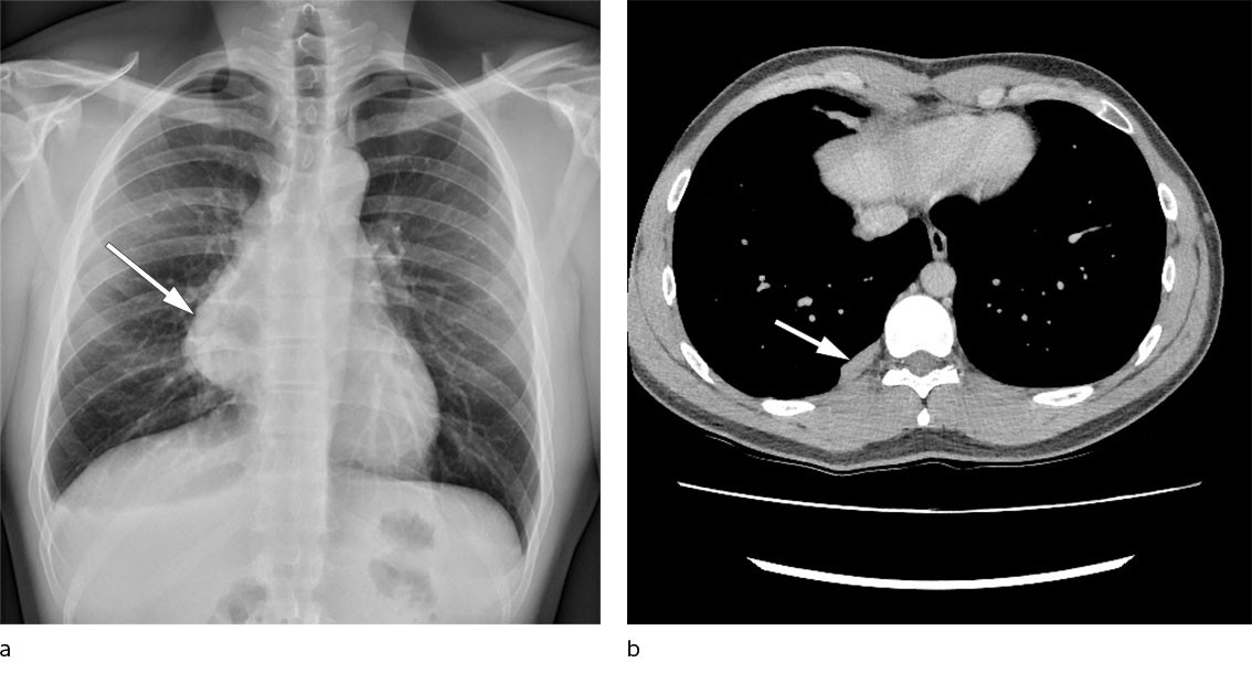 Figure 1 Diagnostic imaging. a) Chest X-ray with finding of mediastinal mass. b) Chest CT with pleural metastases two years&hellip;