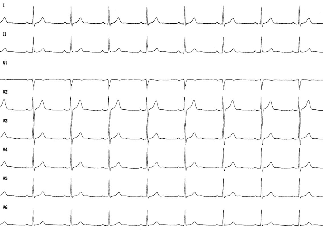 Figur 2 Elektrokardiogram (EKG) etter opph&oslash;r av brystsmerter.