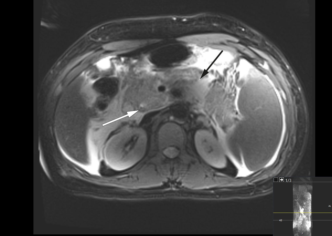 Figure 1 Magnetic resonance cholangiopancreatography (MRCP), transverse plane, taken on the day of admission, shows a&hellip;