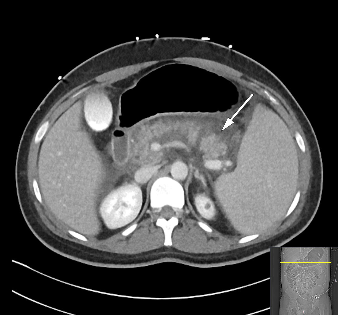 Figure 2 Abdominal CT with intravenous contrast, transverse plane, on day 3 after admission, shows necrotising pancreatitis&hellip;