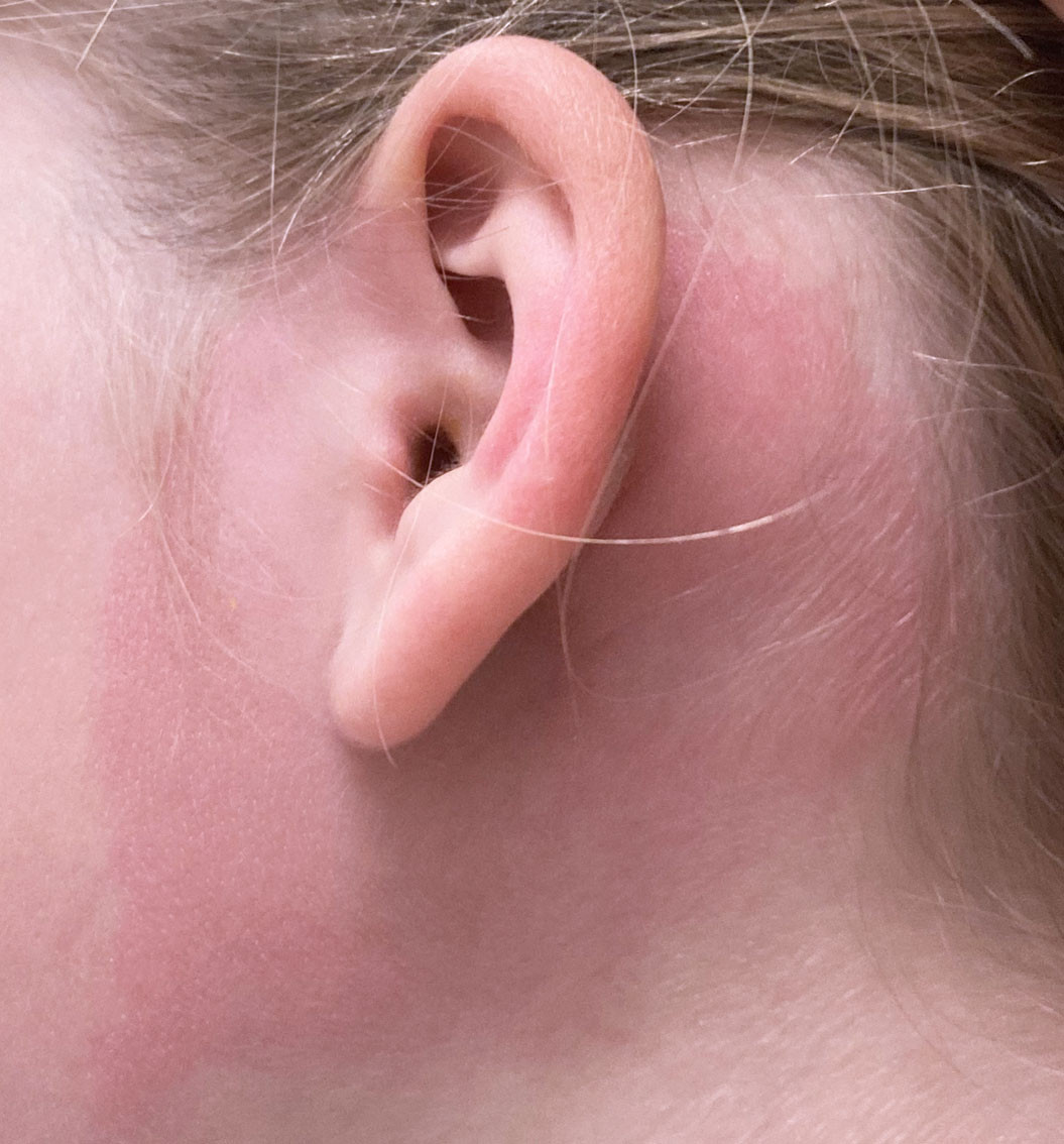 Figur 2 Eit klarare avgrensa makul&aelig;rt erytem kring venstre &oslash;yre og rubor og lett hevelse p&aring; venstre &oslash;yremusling som tilkom&hellip;