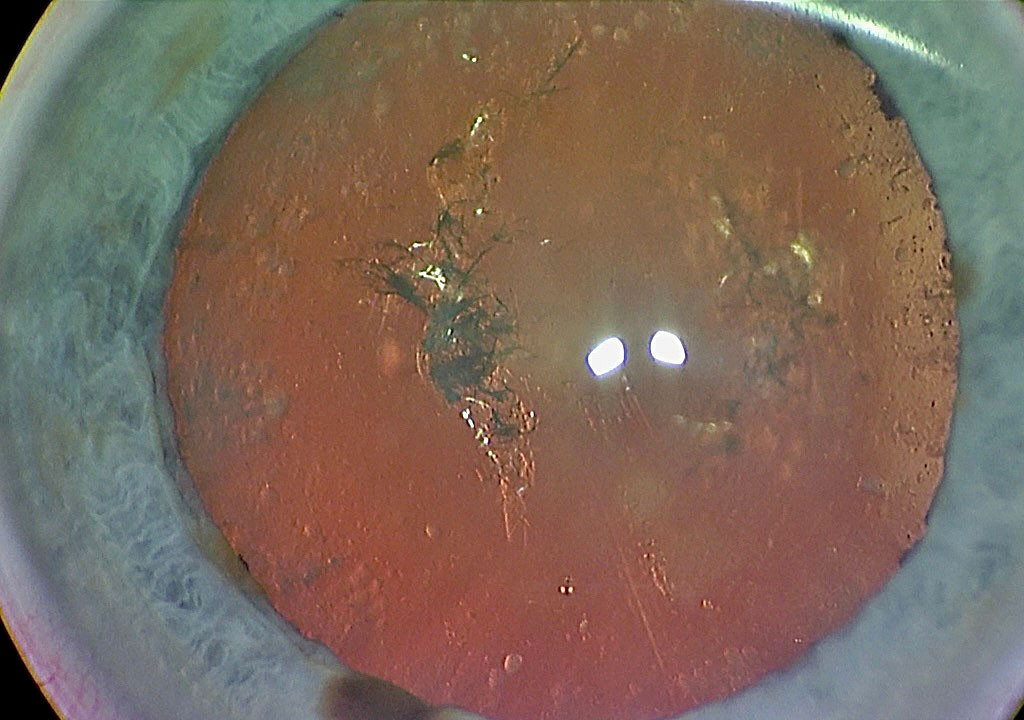 Figur 1 Iriserende katarakt, ogs&aring; kalt &laquo;juletrekatarakt&raquo; er typisk for pasienter med dystrophia myotonica type 1. Foto:&hellip;