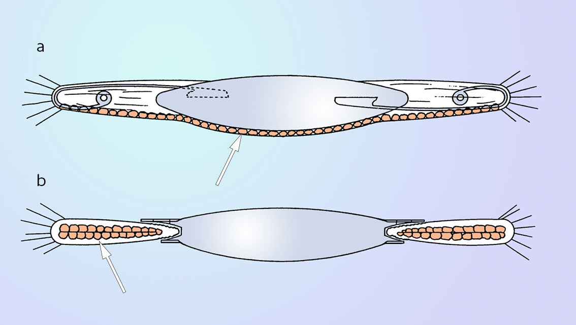 Figur 2 a) Tradisjonell kataraktkirurgi med lens-in-bag. Tegningen viser tverrsnitt av en vanlig kunstig linse i&hellip;