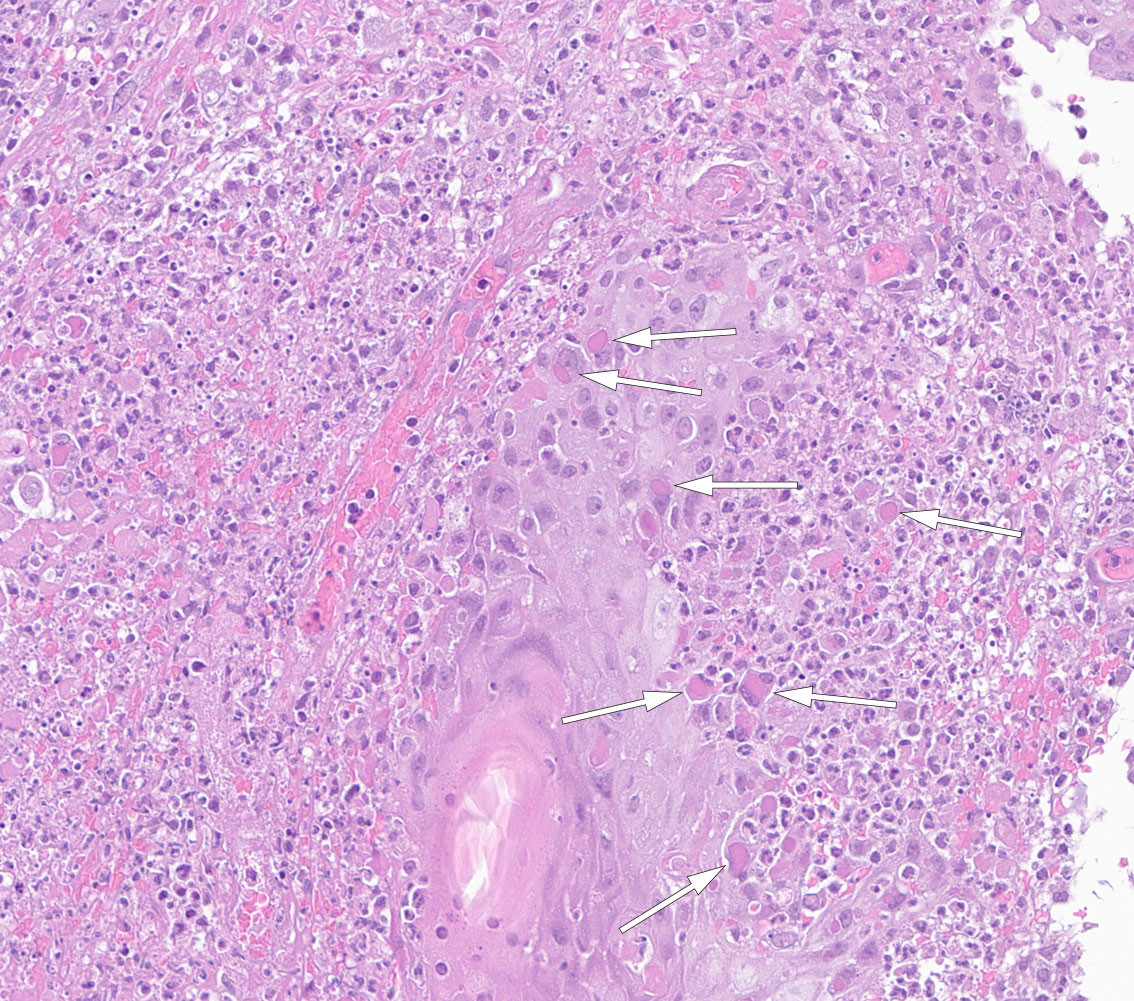 Figur 2 Typisk histologi ved kukopper med eosinofile intracytoplasmatiske inklusjoner (merket med piler) samt subakutt&hellip;