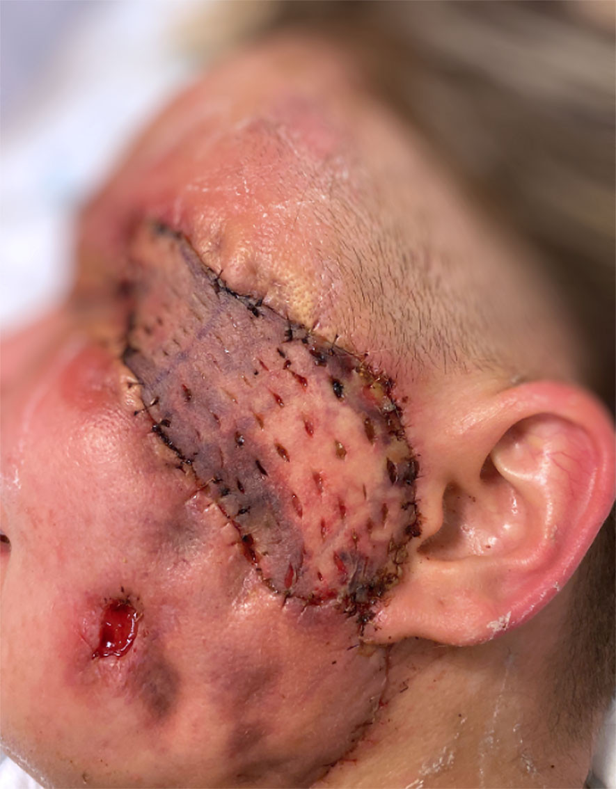 Figur 3 Fullhudstransplantat til ansiktet ble hentet fra venstre overarm.