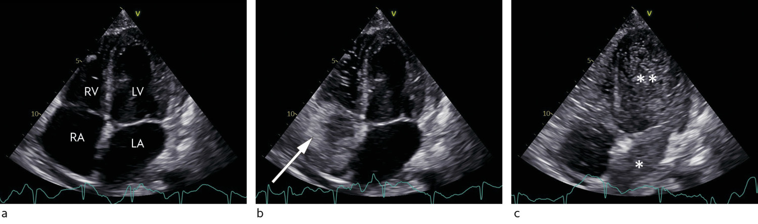 Figure 1 Transthoracic echocardiography with agitated saline contrast. Apical four-chamber view. a) Before infusion of&hellip;