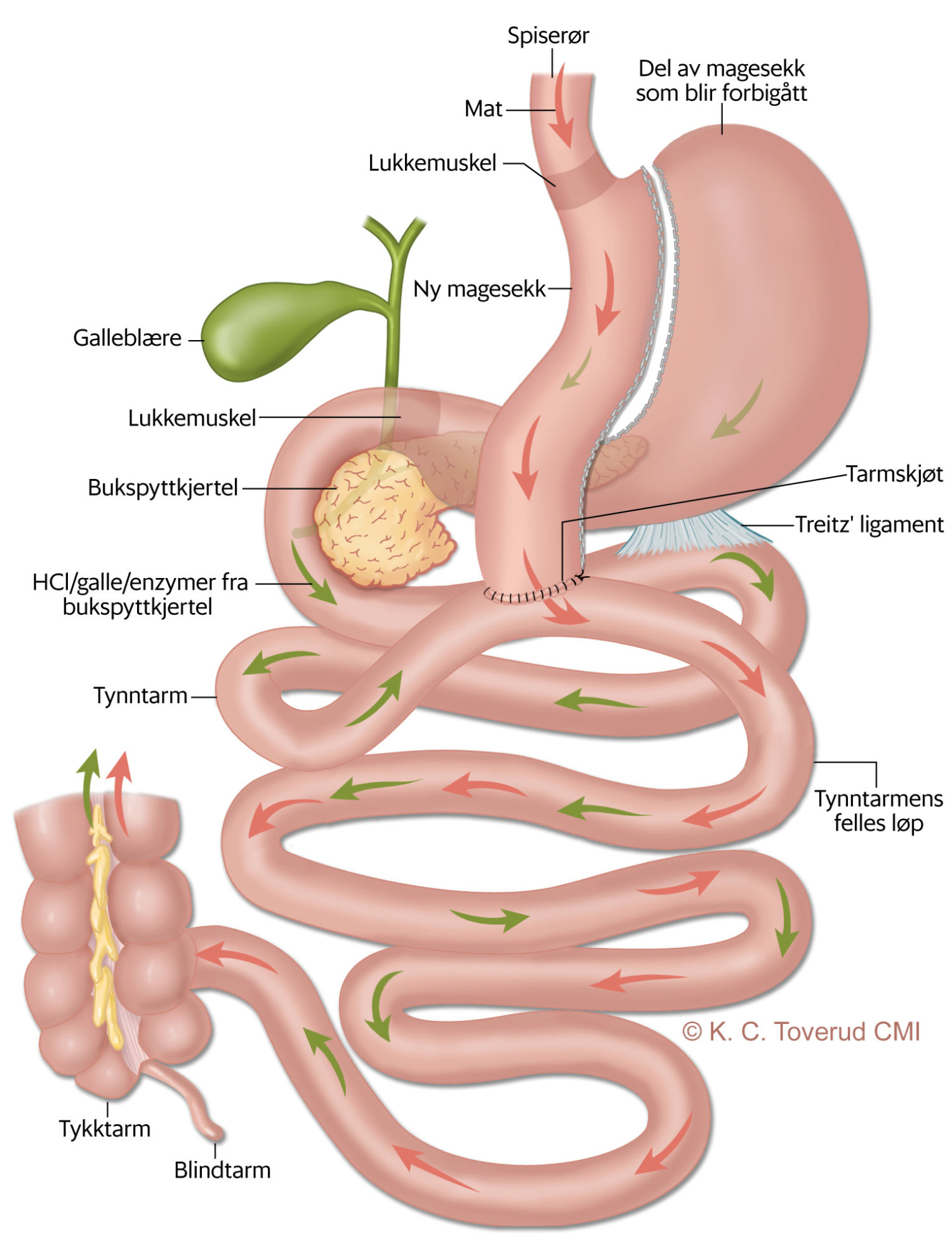 Figur 1 Mini-gastrisk bypass. Ved denne metoden deles magesekken slik at det etableres et langt ventrikkelr&oslash;r, og det&hellip;