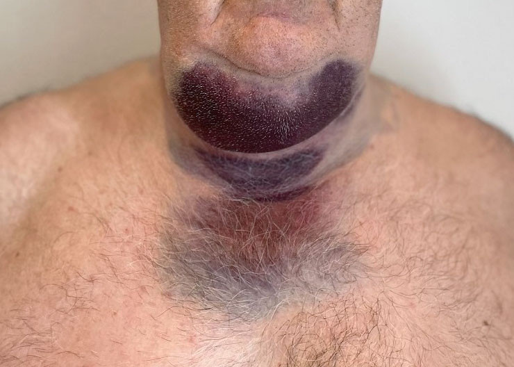 Figur 2 Hematom i midtlinjen p&aring; halsen &aring;tte dager etter symptomdebut. Foto: privat.