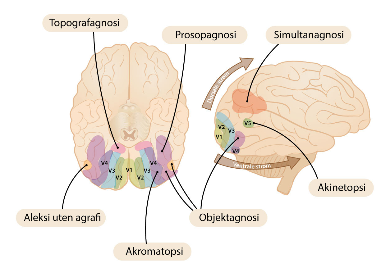 Figur 3 Hjernens synsomr&aring;der og eksempler p&aring; visuell agnosi som kan forekomme ved skader i disse omr&aring;dene. Produsert av&hellip;