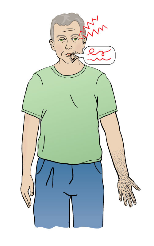 Figure 1 Characteristic of migraine with aura. Gradual onset of visual disturbances such as blurring, scotoma, zigzag lines&hellip;
