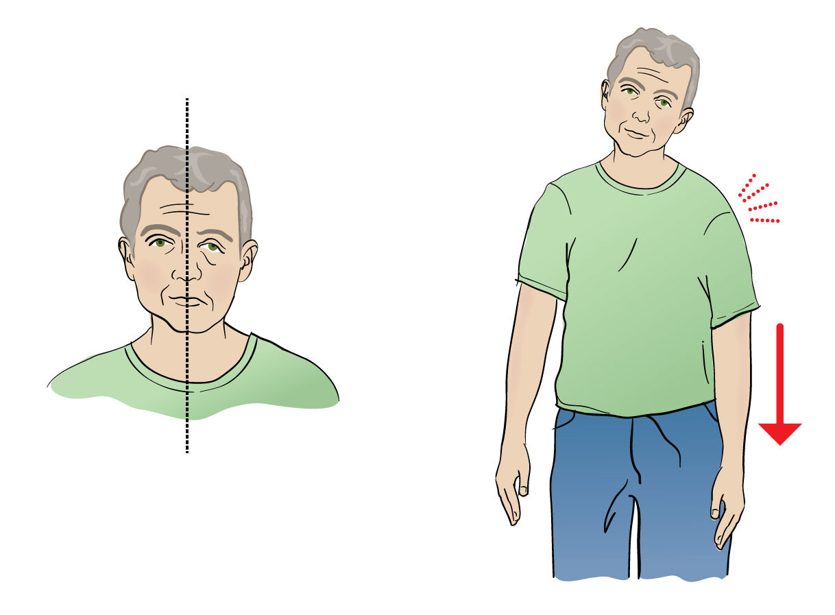 Figure 2 Characteristic of transient ischemic attack (TIA). Acute, short-lived negative neurological symptoms and signs,&hellip;