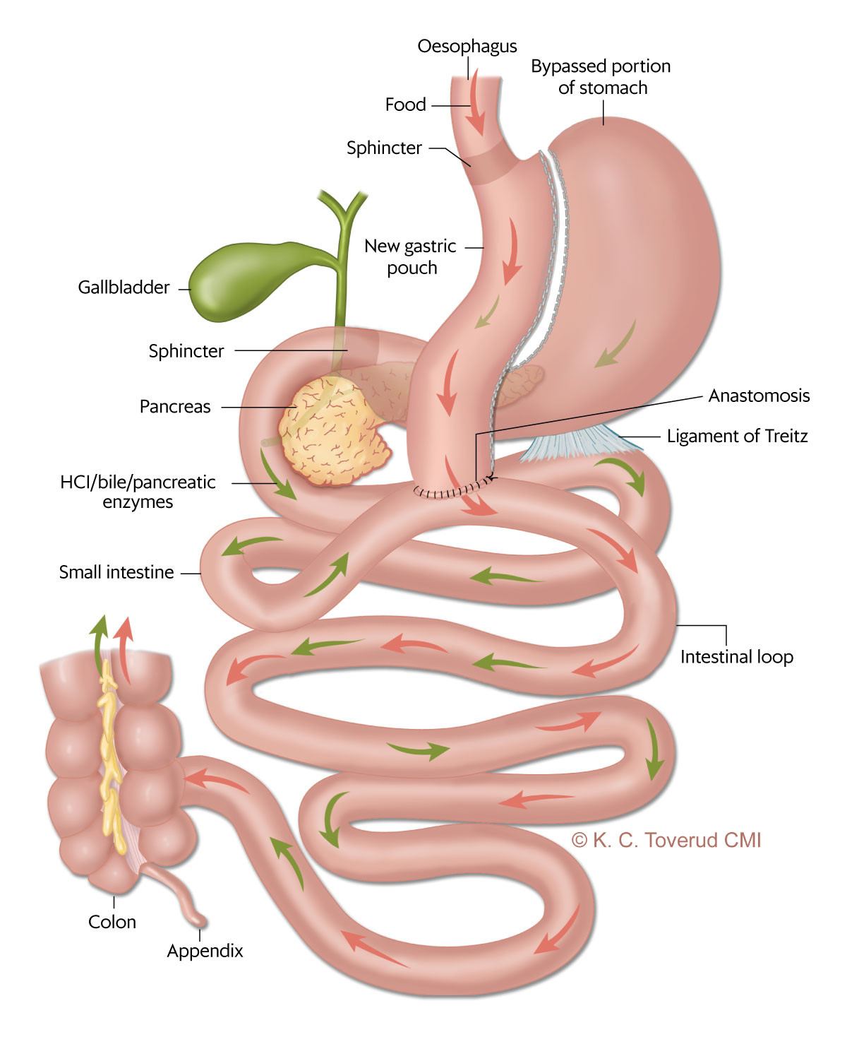 Figure 1 Mini-gastric bypass. With this method, the stomach is divided to create a long tube, with a single intestinal&hellip;