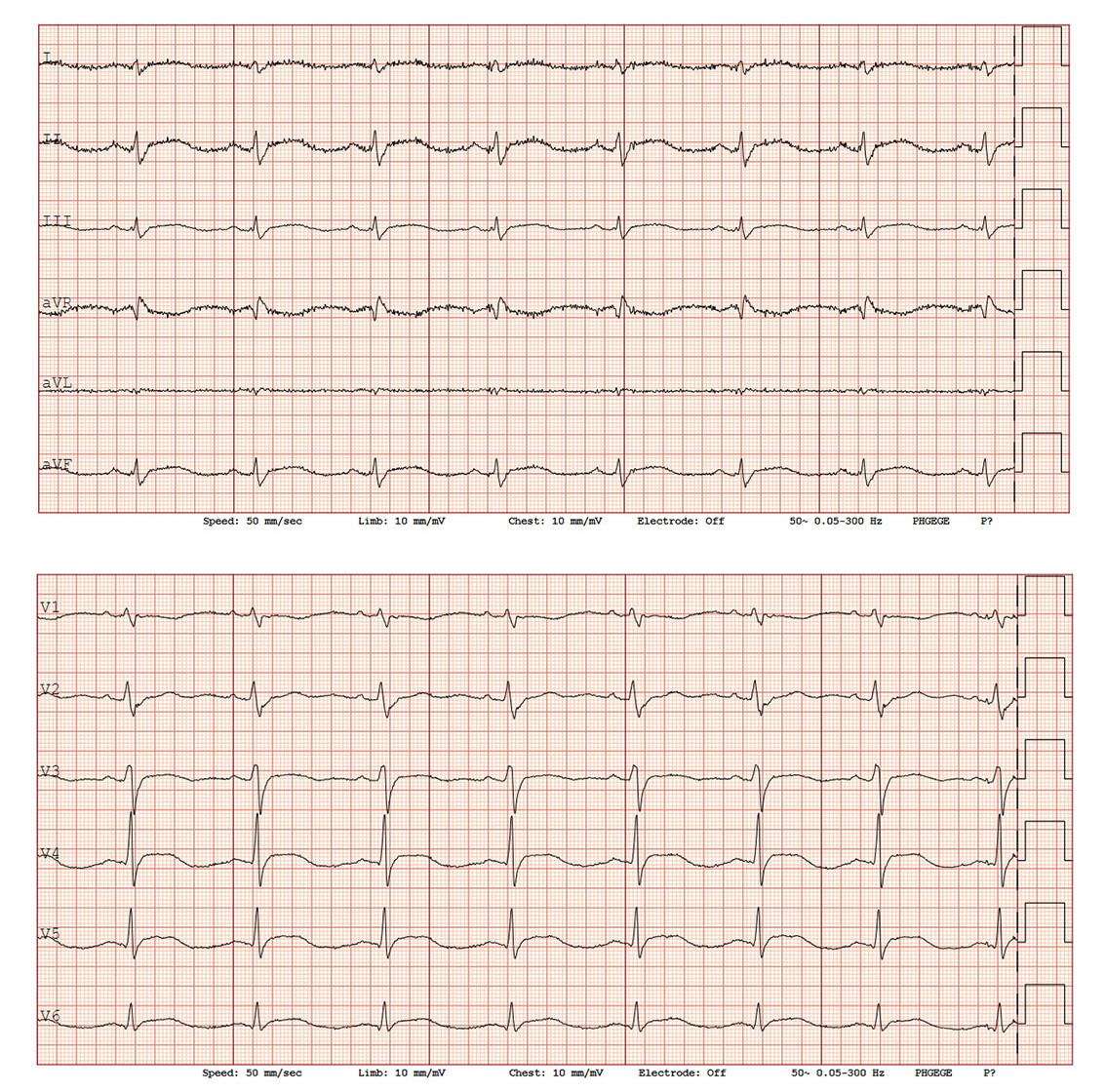 Figur 1 F&oslash;rste EKG p&aring; andre innleggelsesdag viste lett eleverte ST-segmenter i II, III og aVF, samt V3&ndash;V6.