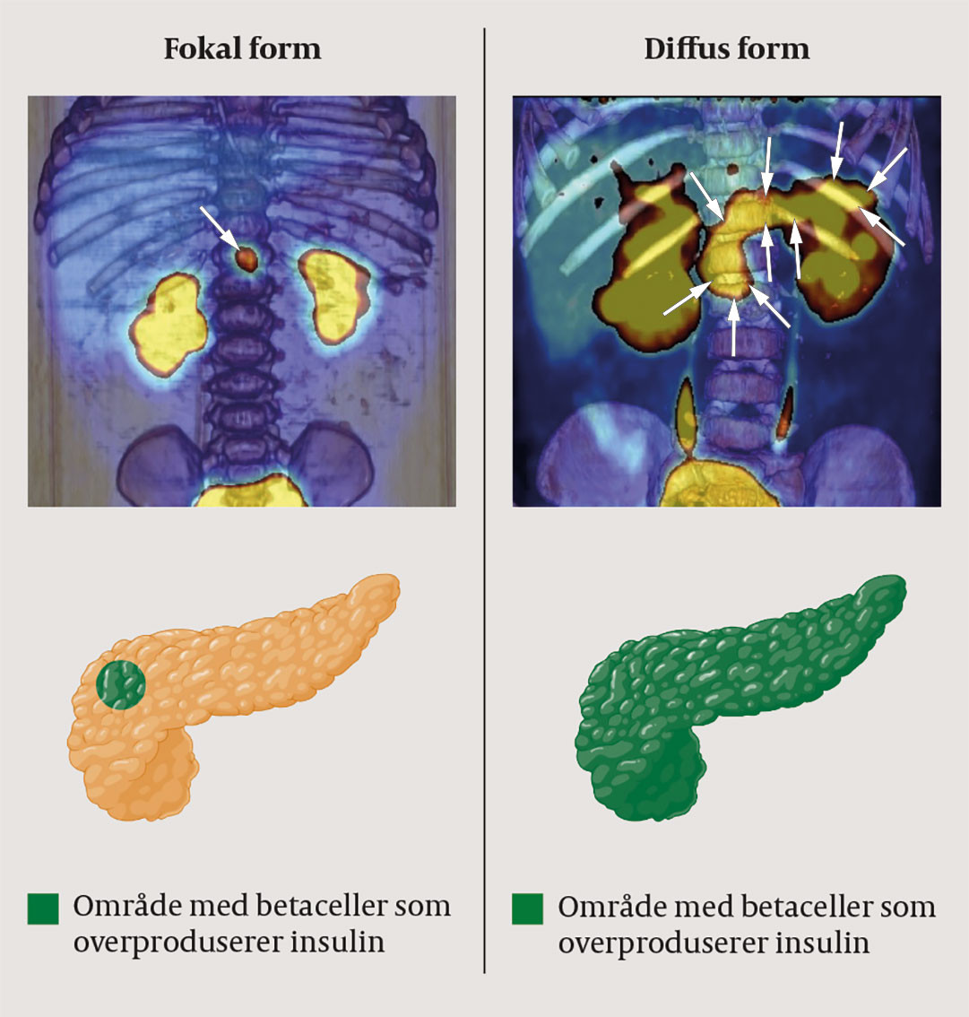 Figur 218F-DOPA-PET-skanning av diffus og fokal form for medf&oslash;dt hyperinsulinisme. Ved fokal form (venstre) er bare deler av&hellip;