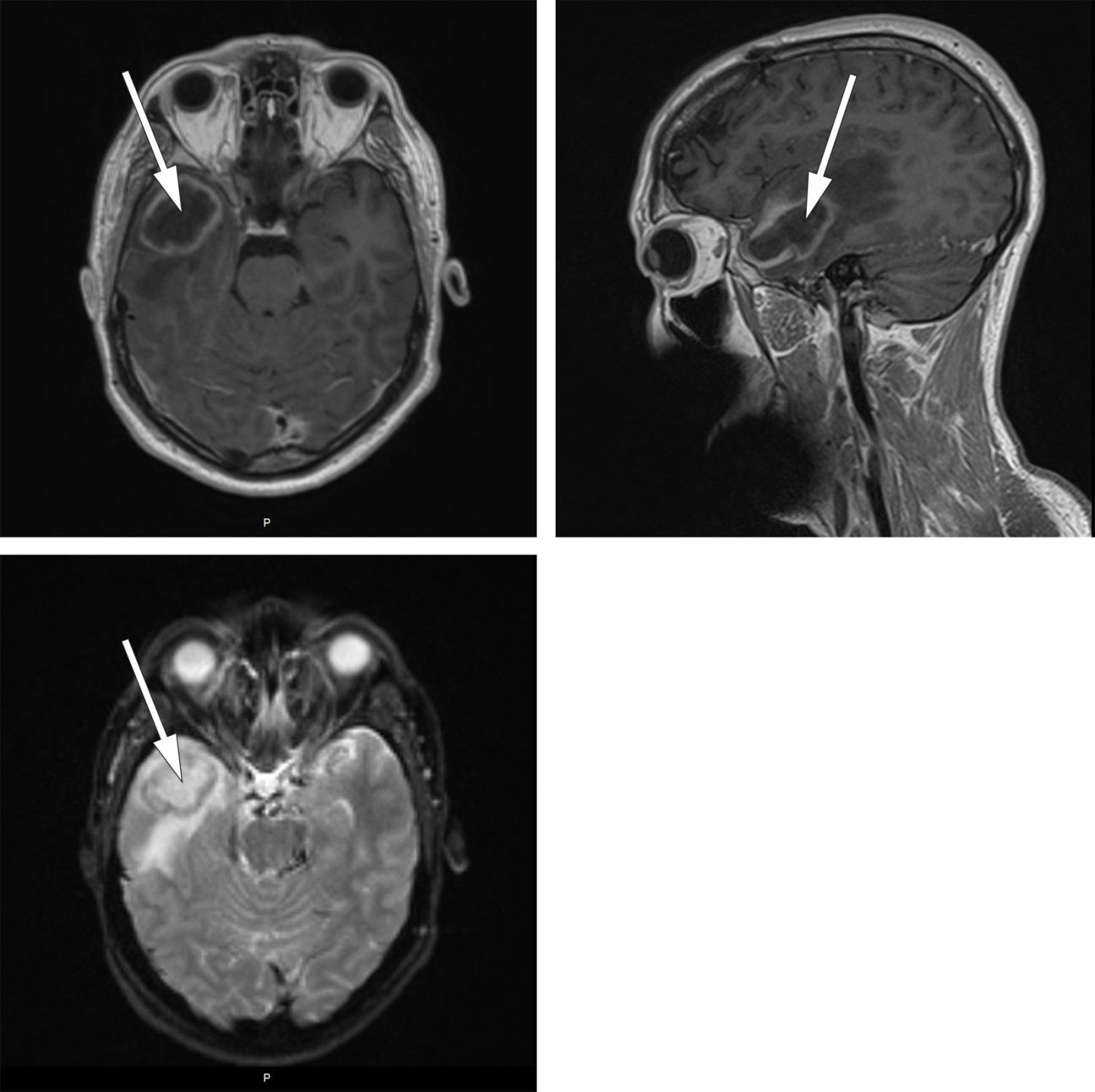 Figur 1 Preoperative MR-bilder viste abscess i h&oslash;yre temporallapp. T1-vekting med kontrast i aksial- og sagittalplan (de to&hellip;