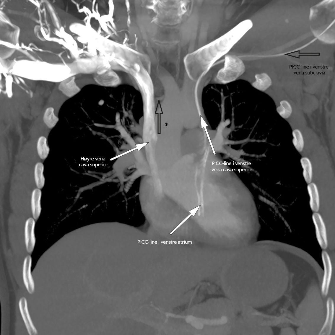Figur 3a CT toraks med intraven&oslash;s kontrast, koronalplan med &oslash;kt tykkelse av snitt. Man kan se at det foreligger en&hellip;