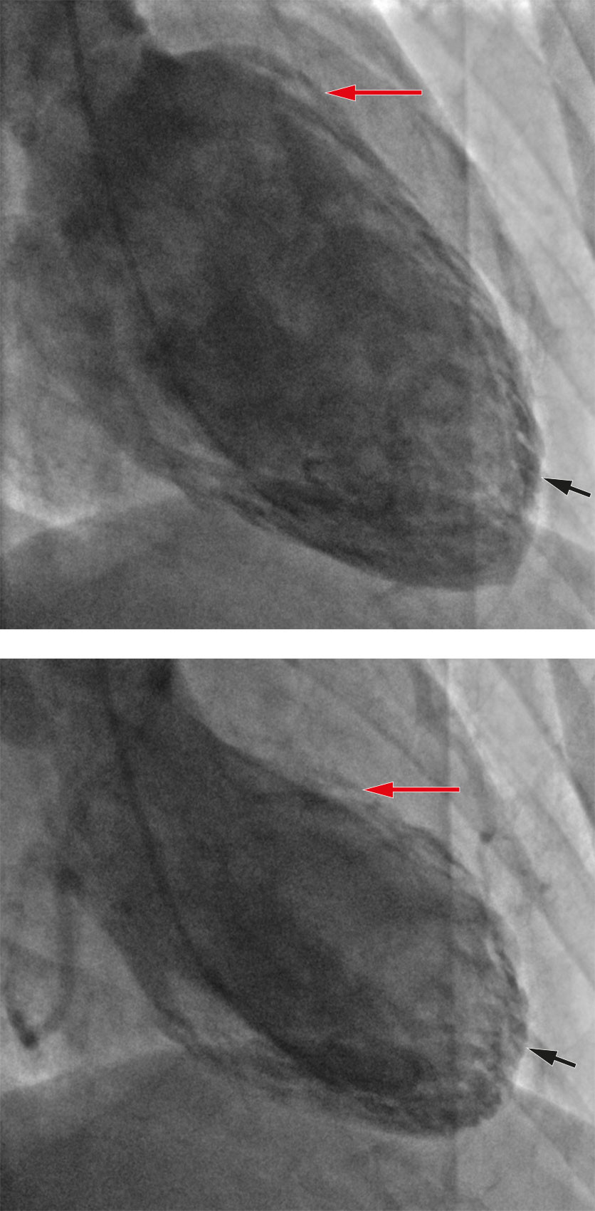 Figure 2 Ventriculography in end-diastole (top) and end-systole (bottom), respectively, showed basal hypercontractility (red&hellip;