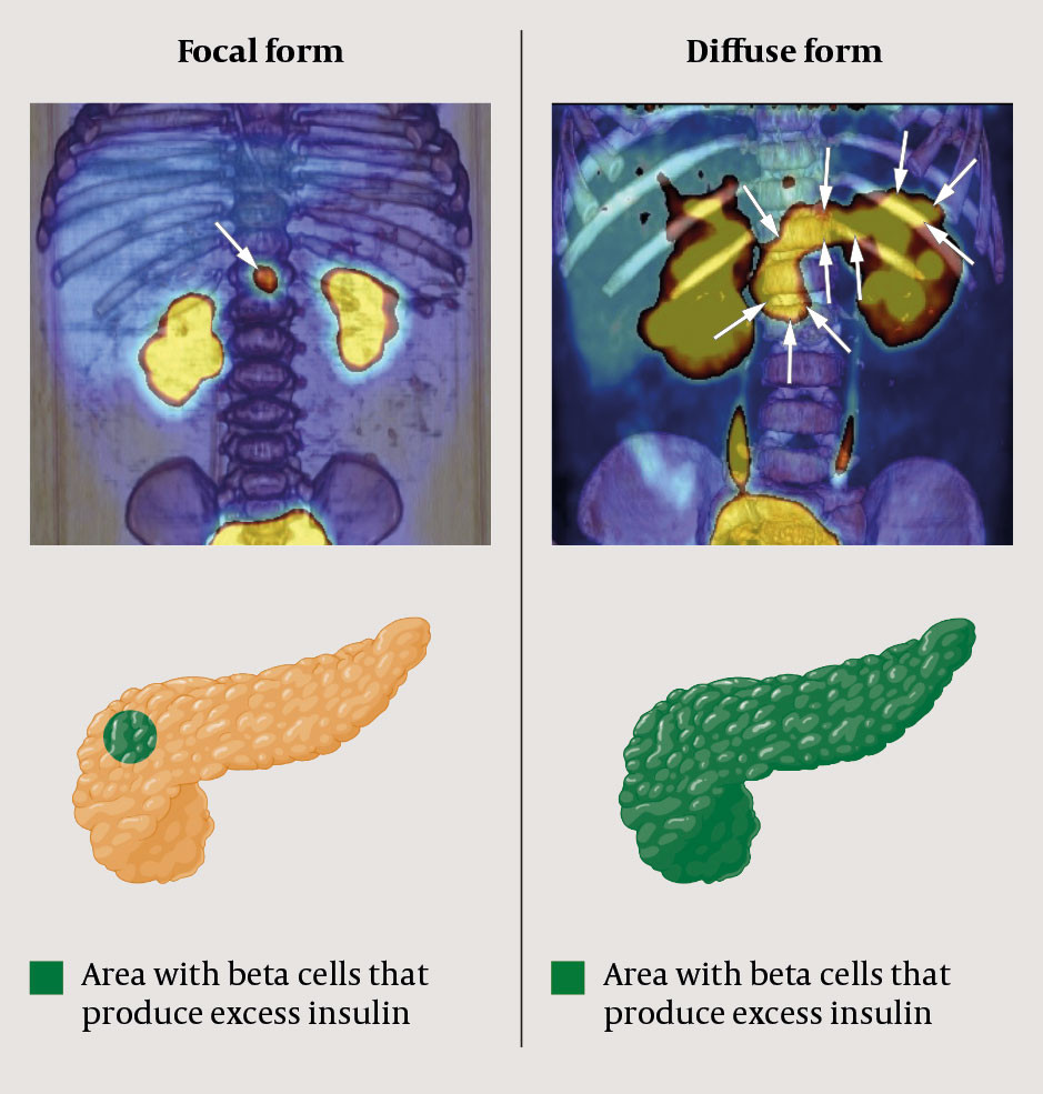 Figure 2 18F-DOPA-PET scan of diffuse and focal form of congenital hyperinsulinism. In the focal form (left), only parts of&hellip;